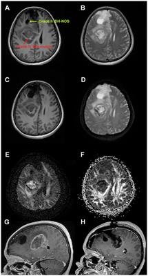 Case report: A 53-year-old woman with synchronous WHO classification II and IV gliomas